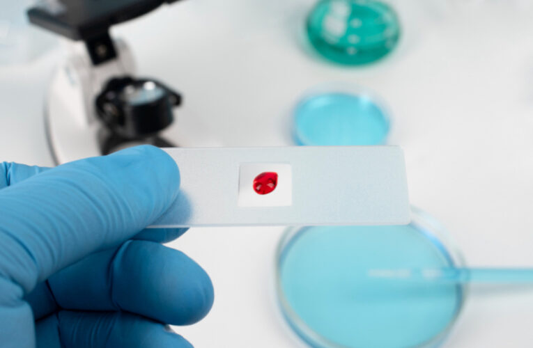 Estudo identifica proteínas envolvidas na eficácia de imunoterapia usada contra câncer no sangue