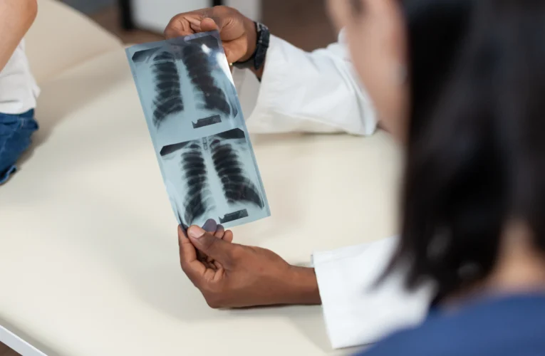 Secretária da Saúde intensifica combate à Tuberculose em Botucatu